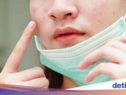 Mengenal ‘Maskne’, Di Jerawat Muncul Sebab Keseringan Pakai Masker