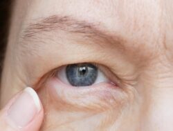 Mengenal Ptosis, Situasi Kelopak Mata yang Disindir Ahli Kemakmuran Tompi