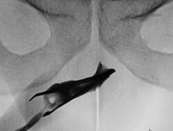 Ngilu! Momen Praktisi Medis Temukan Pinset ‘Nyangkut’ Hingga Mr P Pada 4 Tahun