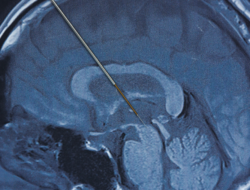 Mengenal Deep Brain Stimulation, Prosedur Sebagai Bantu Kendalikan Parkinson