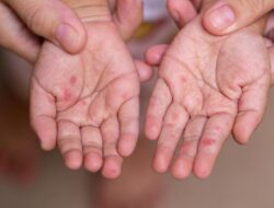 Australia Temukan Mikroba Campak ‘Bawaan’ Di Indonesia, Pakar Soroti Hal Ini