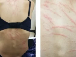 Makan Jamur Shiitake, Punggung Wanita Ini Dipenuhi Ruam Mirip Bekas Cambukan